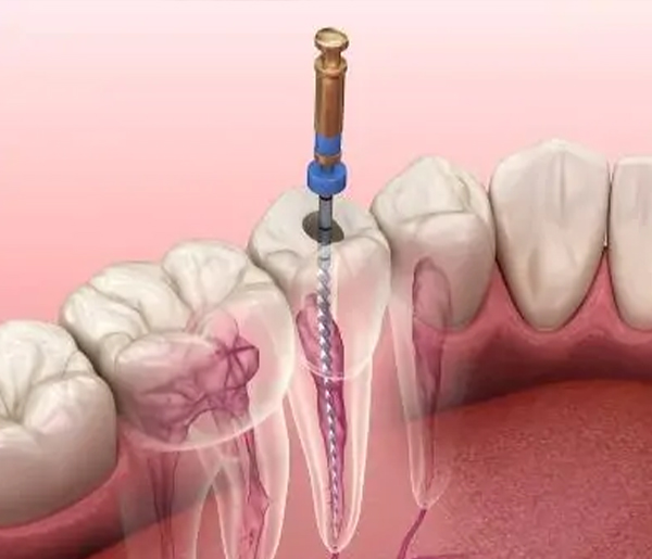 Root Canal Treatment